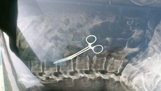 ২০ বছর ধরে কাঁচি পেটে নিয়ে ঘুরছিলেন বাচেনা খাতুন