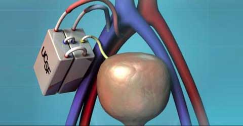 বাজারে আসছে কৃত্রিম কিডনি